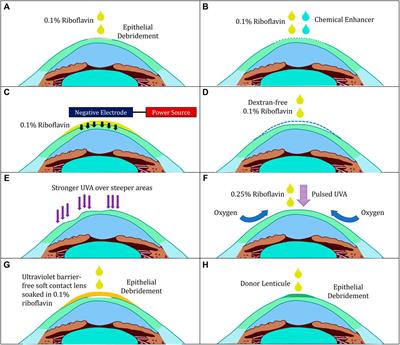 Corneal Cross-Linking: The Evolution of Treatment for Corneal Diseases